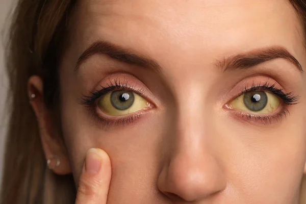 Kobieta Sprawdzająca Stan Zdrowia Zbliżenie Żółte Oczy Jako Objaw Zaburzeń — Zdjęcie stockowe