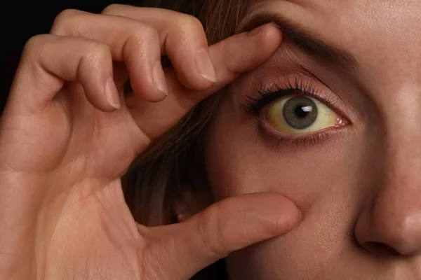 Kobieta Sprawdzająca Stan Zdrowia Zbliżenie Żółte Oczy Jako Objaw Zaburzeń — Zdjęcie stockowe