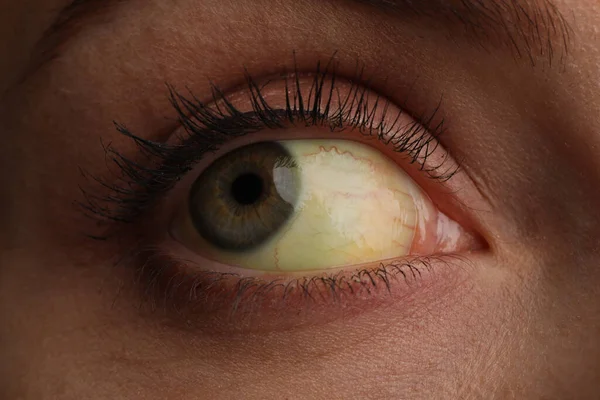 Γυναίκα Κίτρινα Μάτια Κοντινό Πλάνο Συμπτώματα Ηπατικών Προβλημάτων — Φωτογραφία Αρχείου