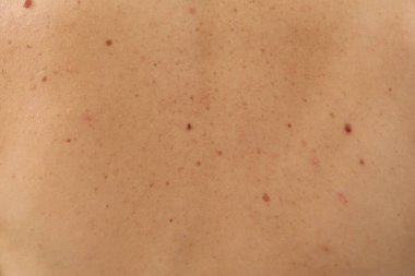 Arka planda doğum lekeleri olan kadın vücuduna yakın çekim