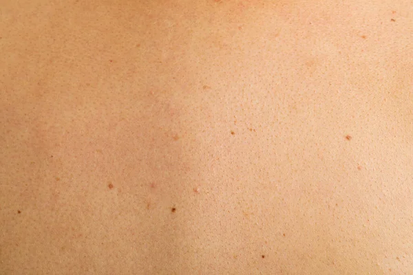 Texture Human Skin Birthmarks Closeup View — Zdjęcie stockowe