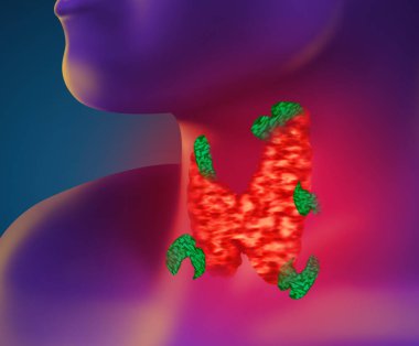 Illustration of human with inflamed thyroid gland on color background clipart