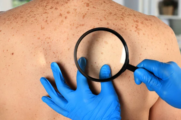 Dermatologist Examining Patient Birthmark Magnifying Glass Closeup — Stock Photo, Image