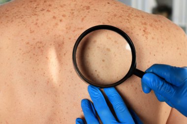 Dermatolog, hastanın doğum lekesini büyüteçle inceliyor.