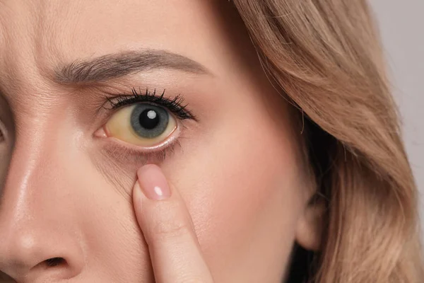 Kobieta Żółtymi Oczami Zbliżenie Objawy Choroby Wątroby — Zdjęcie stockowe