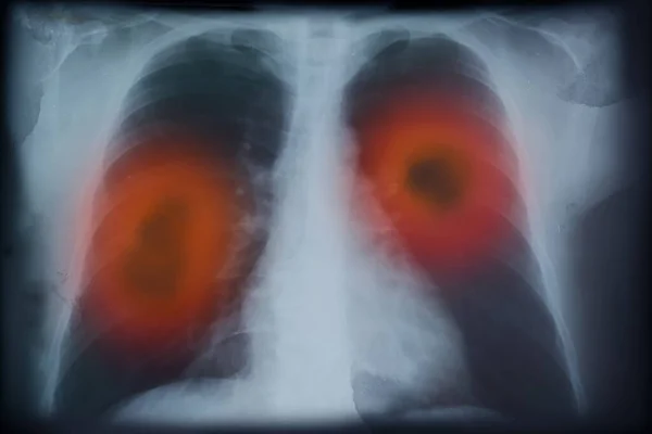 Röntgenkép Tüdőrákos Betegről Illusztráció — Stock Fotó