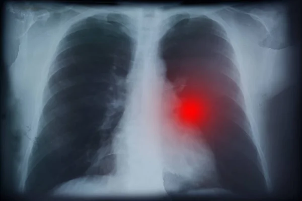 Ray Image Patient Lung Cancer Illustration — Stock Photo, Image