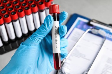 Maymun çiçeği virüsü testi. Laboratuvar çalışanı, üzerinde kan olan örnek tüpü tutuyor. Yakın plan.