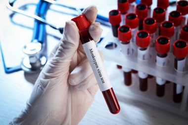 Maymun çiçeği virüsü testi. Laboratuvar çalışanı, üzerinde kan olan örnek tüpü tutuyor. Yakın plan.