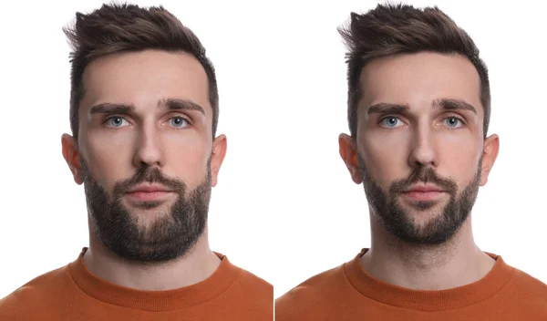 Problema Barbilla Doble Collage Con Fotos Del Hombre Antes Después —  Fotos de Stock
