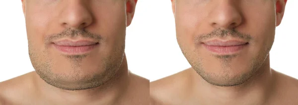 Double Chin Problem Collage Photos Man Plastic Surgery Procedure White — Stock Photo, Image