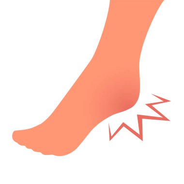 Leg with heel pain. Orthopedic disease plantar fasciitis. Beauty and health of feet. Vector isolated illustration