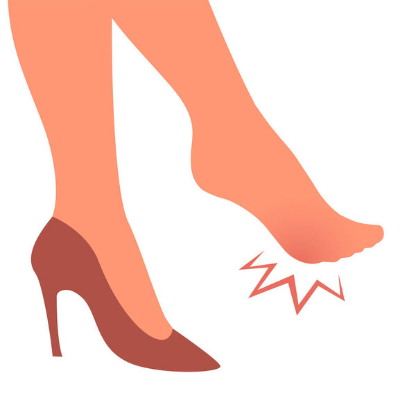 A woman leg with a sore callus. Transverse flat feet. Orthopedic disease. Foot health problems. High heels. Vector isolated illustration