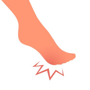 A woman leg with a sore callus. Transverse flat feet. Orthopedic disease. Foot health problems. Vector isolated illustration