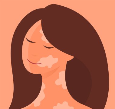 Vitiligo 'su olan genç ve güzel bir kadın. Deri hastalığı. Melanin ve pigmentasyon. Vektör karikatür şirin illüstrasyon