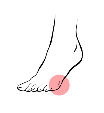 Çizgi, kadın bacağının sorunlu bir resmini çiz. Ortopedik hastalık plantar fasiiti. Ayakların güzelliği ve sağlığı. Vektör izole edilmiş taslak çizimi