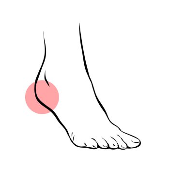 Çizgi, kadın bacağının sorunlu bir resmini çiz. Topuğum ağrıyor. Ortopedik hastalık plantar fasiiti. Ayakların güzelliği ve sağlığı. Vektör izole edilmiş taslak çizimi