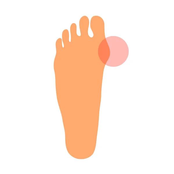 脚のハラックスバルガスの問題 関節と骨の整形外科の変形 女性の足 痛みと癒し 健康管理 白地に孤立したベクトル図 — ストックベクタ