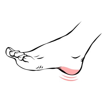 Çizgi, kadın bacağının sorunlu bir resmini çiz. Topuğum ağrıyor. Ortopedik hastalık plantar fasiiti. Ayakların güzelliği ve sağlığı. Vektör izole edilmiş taslak çizimi