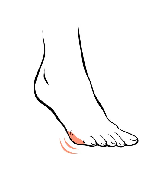 Line Sketch Female Leg Problematic Pain Beauty Health Feet Outline — 图库照片