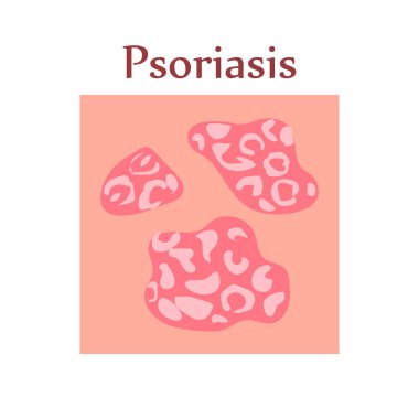 İnsan derisinde sedef hastalığı. Dermatolojik hastalık. Belirtileri kaşıntı, acı, kabuk soyma, kızarıklık ve kızarıklık. Alerjik reaksiyon. Tıbbi teşhis ve tedavi. Vektör illüstrasyonu