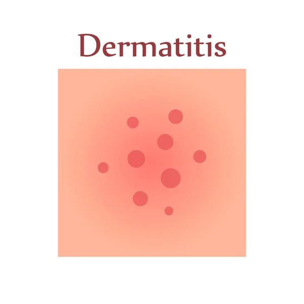 Dermatitis Human Skin Dermatological Disease Symptom Itching Pain Redness Rash — Stockvector