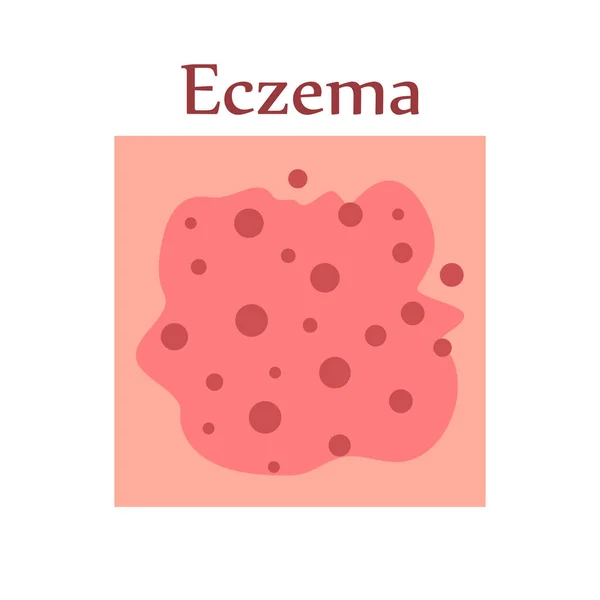 Екзема Шкірі Людини Дерматологічні Захворювання Симптомою Свербіж Біль Почервоніння Висип — стоковий вектор