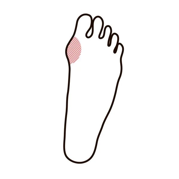脚のハラックスバルガスの問題 関節と骨の整形外科の変形 女性の足 痛みと癒し 健康管理 ベクトルアウトライン図白背景に分離されたインフォグラフィック — ストックベクタ