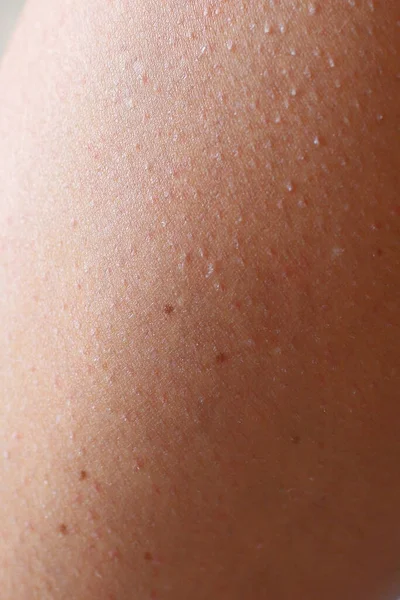 Depilação Cabelo Pele Após Remoção — Fotografia de Stock