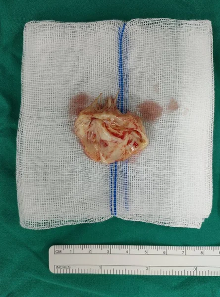 Mitral kapakçık yenilemesi sırasında mitral stenoz tanısı koyan hastadan mitral kapakçık çıkarıldı. Bu da açık kalp ameliyatıdır. Ölçek için bir cetvel var.