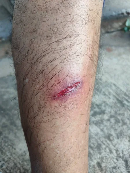 Deep Open Wounds Risk Infection Shin Leg Area Caused Hard — Fotografie, imagine de stoc