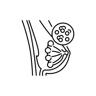 Mastitis renk çizgisi simgesi. İnsan hastalıkları. Web sayfası, mobil uygulama, tanıtım için resim grafiği.