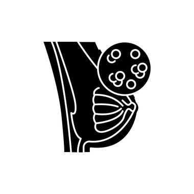 Mastitis renk çizgisi simgesi. İnsan hastalıkları. Web sayfası, mobil uygulama, tanıtım için resim grafiği.