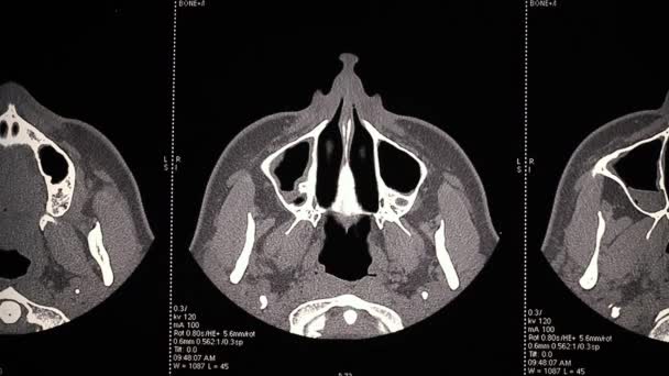 Computertomografie van paranasale sinuses.mov — Stockvideo