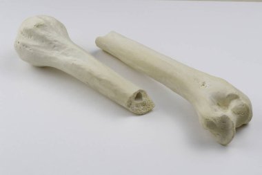 Kemik kırıklarına karşı osteosentez için cerrahi plakalar