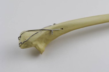 Kemik kırıklarına karşı osteosentez için cerrahi plakalar