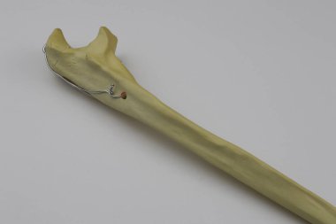 Kemik kırıklarına karşı osteosentez için cerrahi plakalar