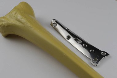 Kemik kırıklarına karşı osteosentez için cerrahi plakalar