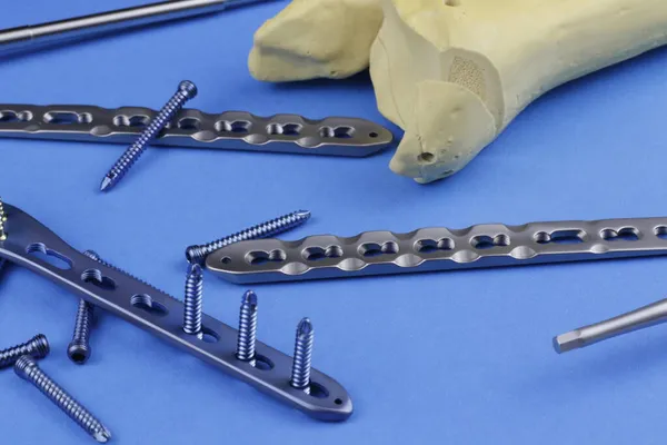 骨折の場合の骨合成のための外科的プレート — ストック写真
