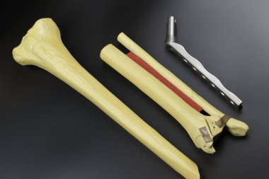 Kemik kırıklarına karşı osteosentez için cerrahi plakalar