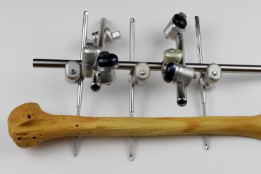 Kemik kırıklarına karşı osteosentez için cerrahi plakalar