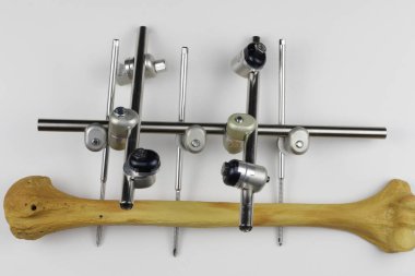 Kemik kırıklarına karşı osteosentez için cerrahi plakalar