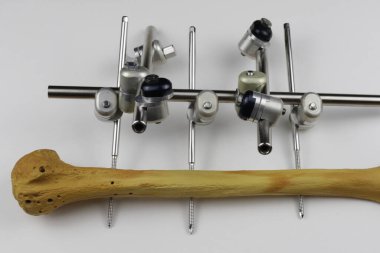 Kemik kırıklarına karşı osteosentez için cerrahi plakalar