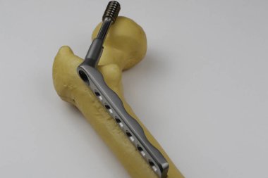 Kemik kırıklarının tedavisi için cerrahi aletler.