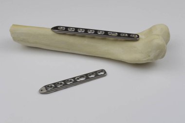 Kemik kırıklarının tedavisi için cerrahi aletler.