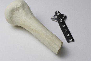 Kemik kırıklarına karşı osteosentez için cerrahi plakalar