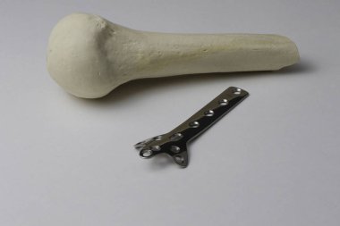 Kemik kırıklarına karşı osteosentez için cerrahi plakalar
