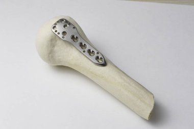 Kemik kırıklarına karşı osteosentez için cerrahi plakalar