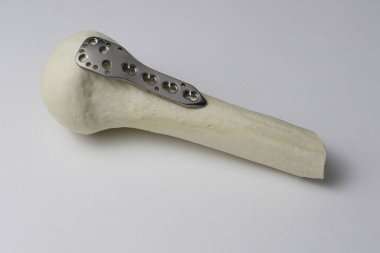 Kemik kırıklarına karşı osteosentez için cerrahi plakalar