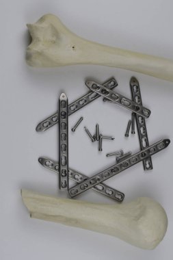 Kemik kırıklarına karşı osteosentez için cerrahi plakalar